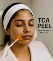 TCA Peel (Trichloroacetic Acid Peel)