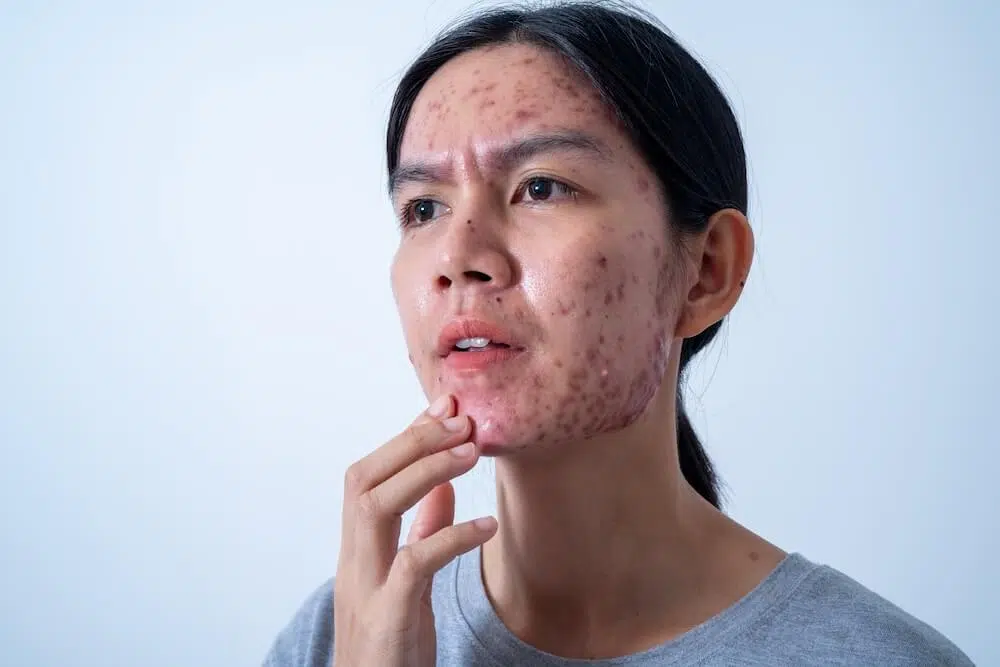 Women’s Acne Treatment: Effective Solutions Every Woman Should Know