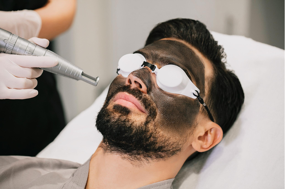 Carbon Facial (Laser Peel)